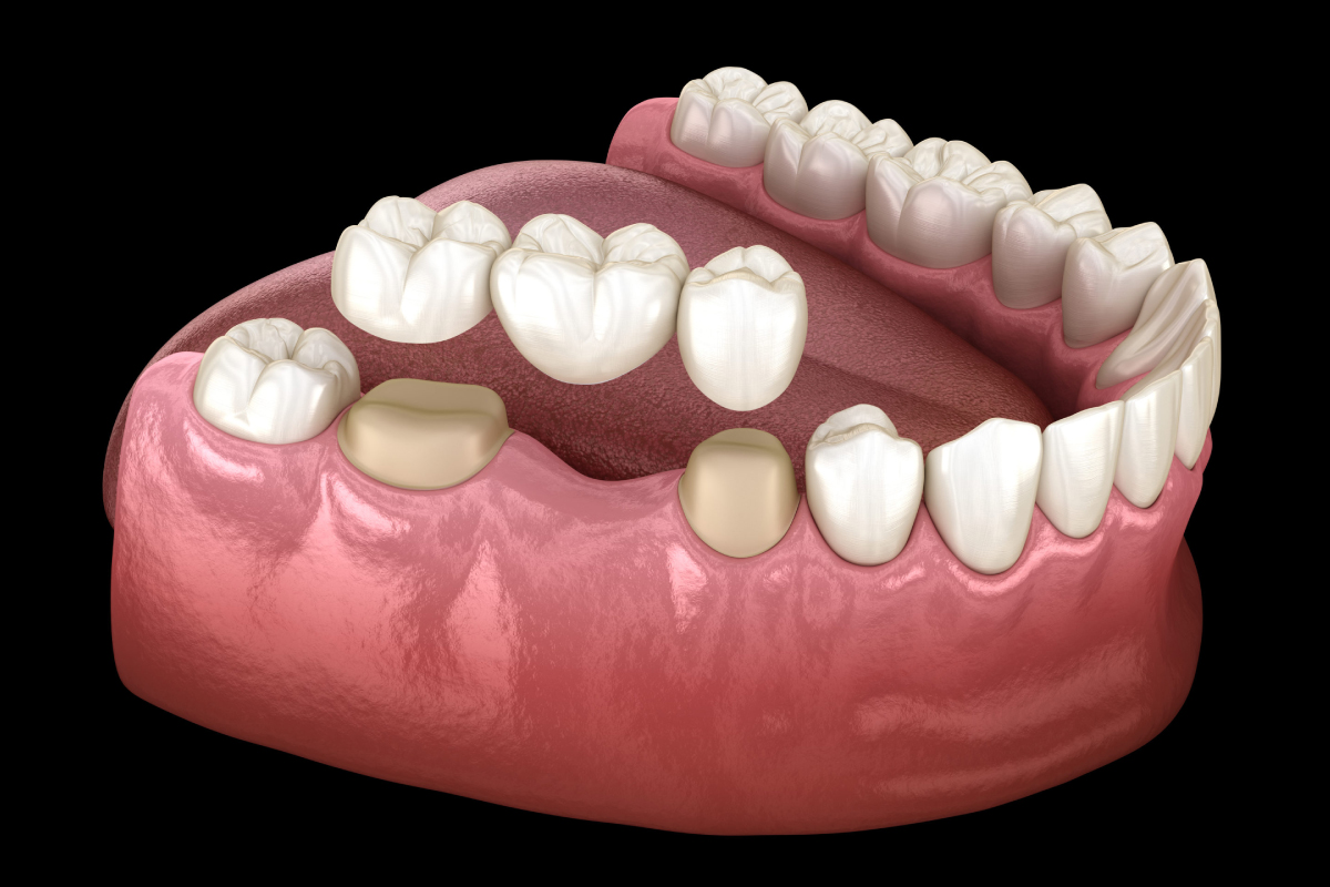 https://albania.mm-turismodentale.com/wp-content/uploads/2023/05/dental-crowns.jpg