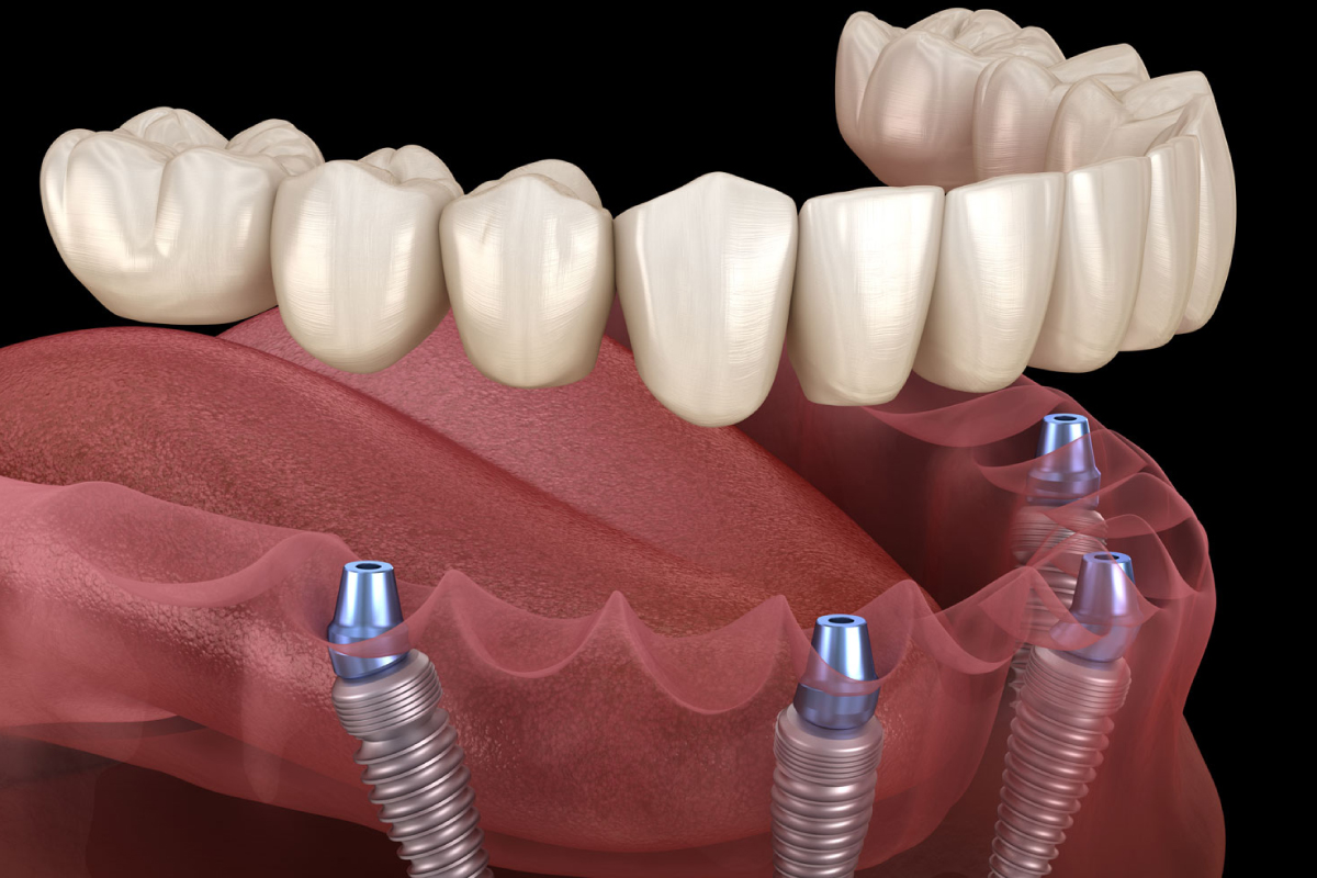 https://albania.mm-turismodentale.com/wp-content/uploads/2023/05/dental-implants.jpg