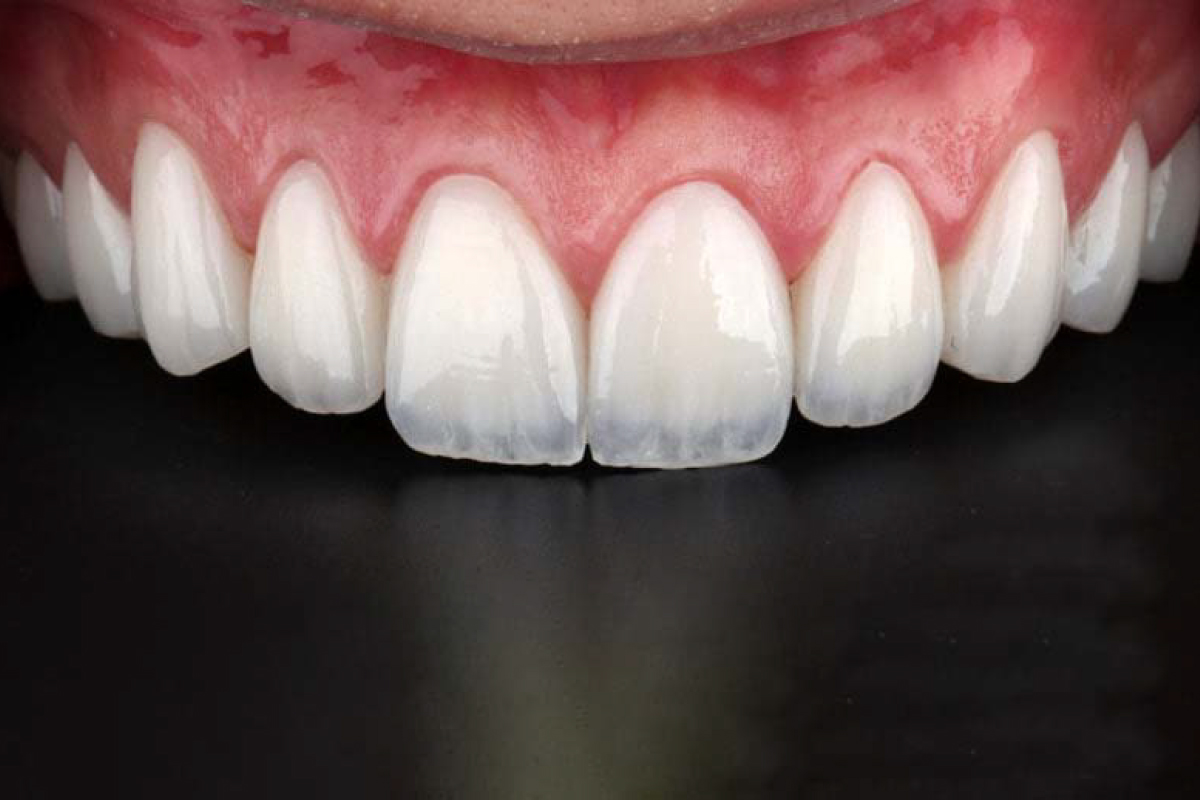 https://albania.mm-turismodentale.com/wp-content/uploads/2023/05/hollywood-smile.jpg